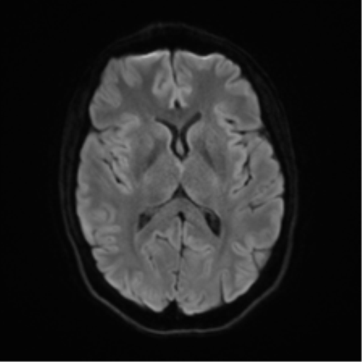 Anaplastic astrocytoma IDH mutant (Radiopaedia 50046-55341 Axial DWI 42).png