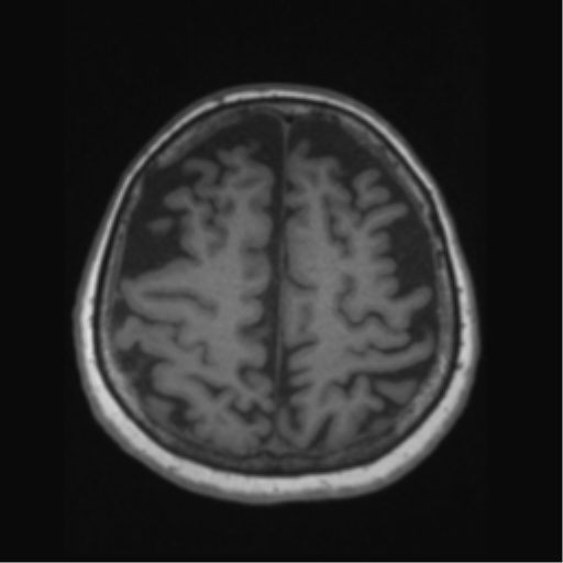Anaplastic astrocytoma IDH wild-type (pseudoprogression) (Radiopaedia 42209-45276 Axial T1 113).png