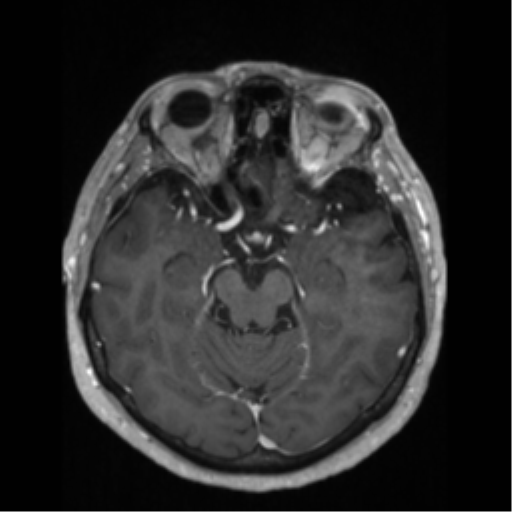 File:Anaplastic astrocytoma IDH wild-type (pseudoprogression) (Radiopaedia 42209-45276 Axial T1 C+ 60).png
