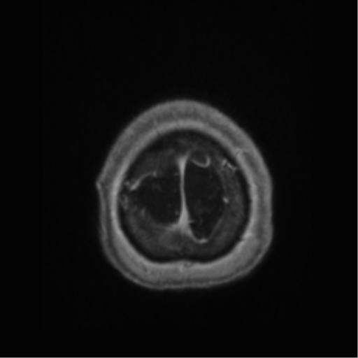 Anaplastic astrocytoma IDH wild-type (pseudoprogression) (Radiopaedia 42209-45277 Axial T1 C+ 124).png