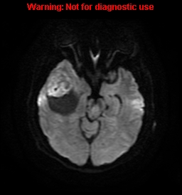 File:Anaplastic ganglioglioma (Radiopaedia 44921-48831 Axial DWI 10).jpg