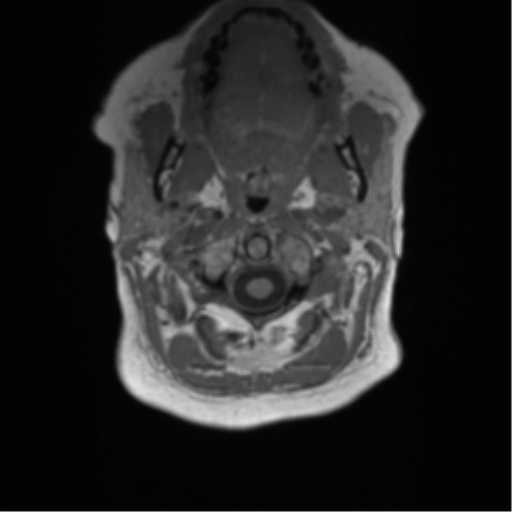 Anaplastic oligodendroglioma (Radiopaedia 83500-98599 Axial T1 1).png