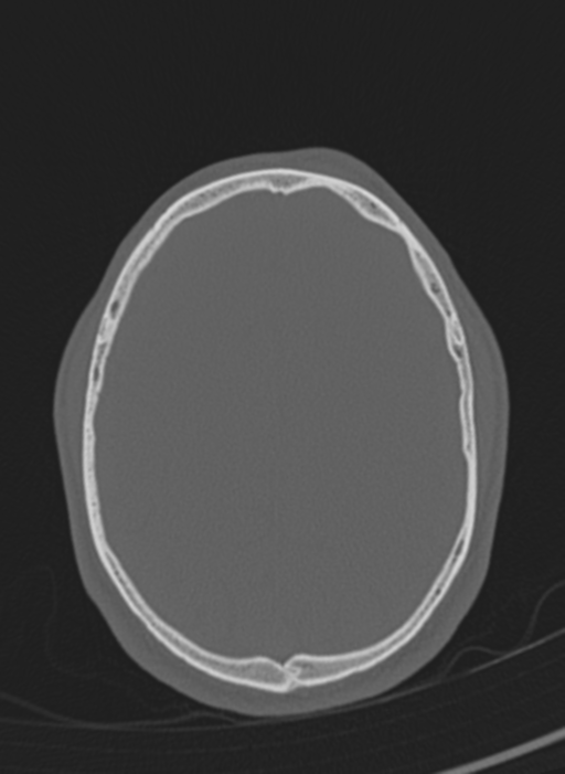 Anaplastic oligodendroglioma with skull fracture (Radiopaedia 74831-85846 Axial bone window 11).png