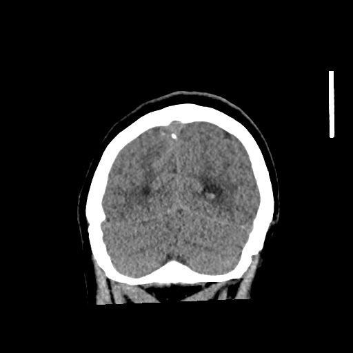 Aneursym related subarachnoid hemorrhage with hydrocephalus (Radiopaedia 45105-49083 Coronal non-contrast 56).jpg