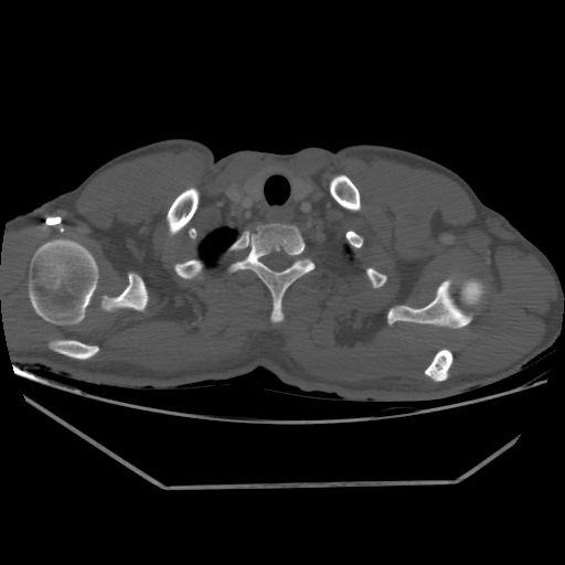 Aneurysmal bone cyst - rib (Radiopaedia 82167-96220 Axial bone window 39).jpg