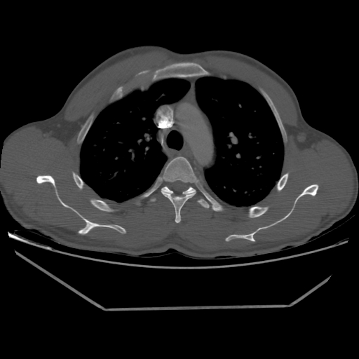 Aneurysmal bone cyst - rib (Radiopaedia 82167-96220 Axial bone window 96).jpg