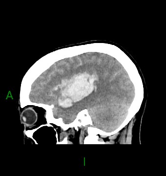 File:Aneurysmal subarachnoid hemorrhage with intra-axial extension (Radiopaedia 84371-99699 B 14).jpg