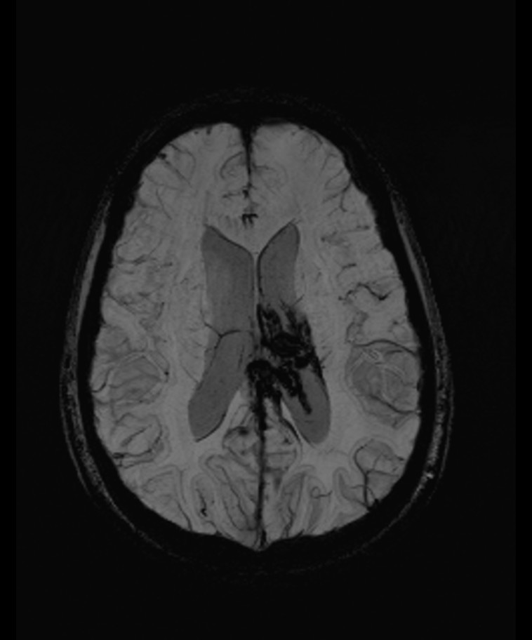 Angiomatous meningioma (Radiopaedia 79459-92579 E 40).jpg