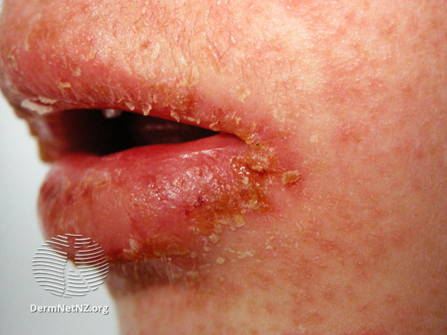 File:Angular cheilitis (DermNet NZ site-age-specific-perleche13).jpg