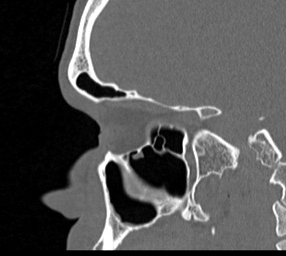 Angular epidermoid cyst (Radiopaedia 46908-51439 Sagittal bone window 59).png