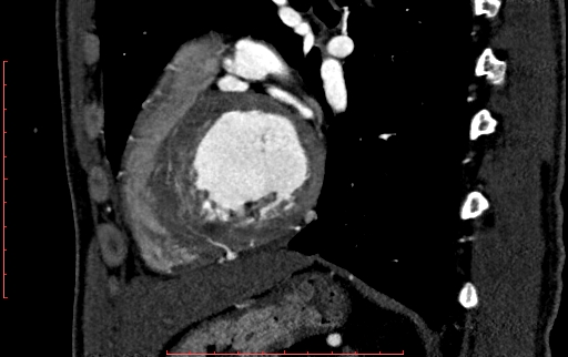 File:Anomalous left coronary artery from the pulmonary artery (ALCAPA) (Radiopaedia 70148-80181 C 170).jpg