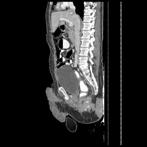 Anorectal carcinoma (Radiopaedia 44413-48064 C 47).jpg
