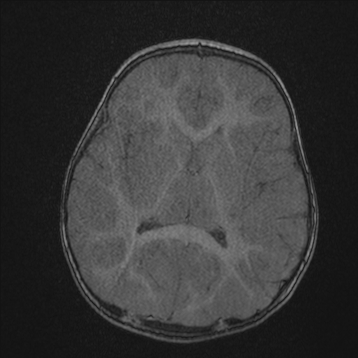 Anoxic brain injury (Radiopaedia 79165-92139 Axial MRA 136).jpg