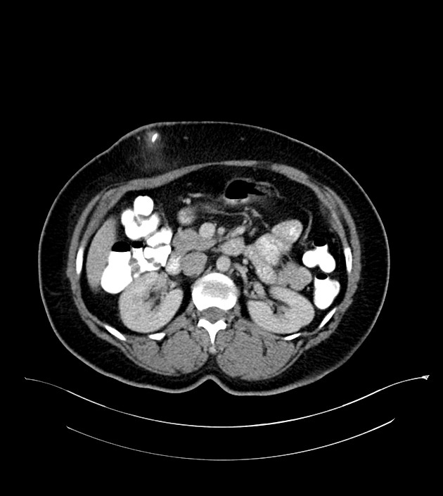 Anterior abdominal wall CSF pseudocyst (CSFoma) (Radiopaedia 79453-92571 A 38).jpg