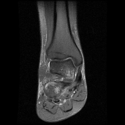 File:Anterior calcaneal process fracture (Radiopaedia 71377-81705 Coronal PD fat sat 6).jpg