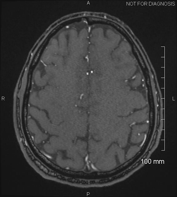 Anterior cerebral artery aneurysm (Radiopaedia 80683-94127 Axial MRA 193).jpg
