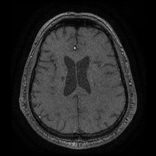 Anterior cerebral artery infarction (Radiopaedia 46794-51323 Axial MRA 148).jpg
