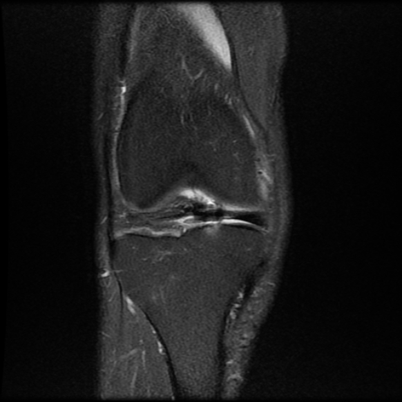 File:Anterior cruciate ligament graft tear and bucket-handle tear of medial meniscus (Radiopaedia 75867-87254 Coronal PD fat sat 8).jpg