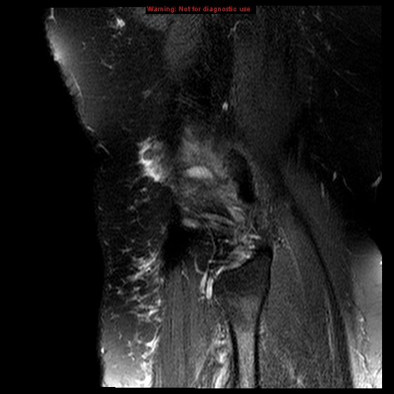 File:Anterior cruciate ligament tear (Radiopaedia 12329-12612 E 2).jpg