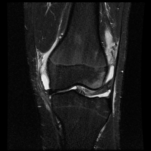 File:Anterior cruciate ligament tear (Radiopaedia 61500-69462 Coronal STIR 9).jpg