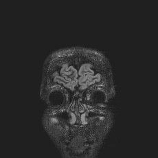 Anterior temporal encephalocele (Radiopaedia 82624-96808 Coronal FLAIR 2).jpg