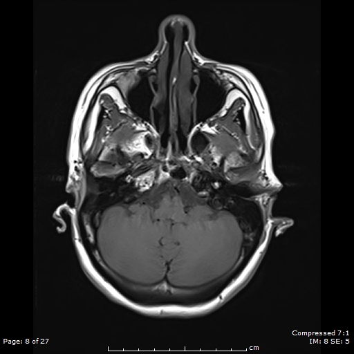 File:Anterior temporal lobe perivascular space (Radiopaedia 88283-104914 Axial T1 8).jpg