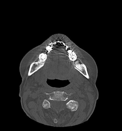 Anterior temporomandibular joint dislocation (Radiopaedia 59430-66784 Axial non-contrast 44).jpg