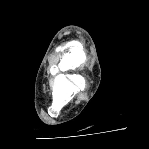 File:Anterior tibial artery false aneurysm (Radiopaedia 88984-105809 A 155).jpg