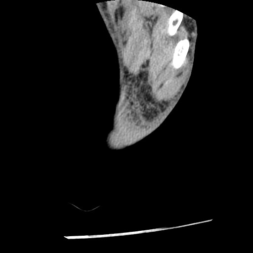 Anterior tibial artery false aneurysm (Radiopaedia 88984-105809 A 258).jpg