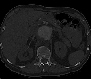 File:Anterior vertebral scalloping (abdominal aortic aneurysm) (Radiopaedia 66744-76067 Axial bone window 36).jpg