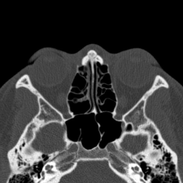 Antrochoanal polyp (Radiopaedia 33984-35202 Axial bone window 47).jpg