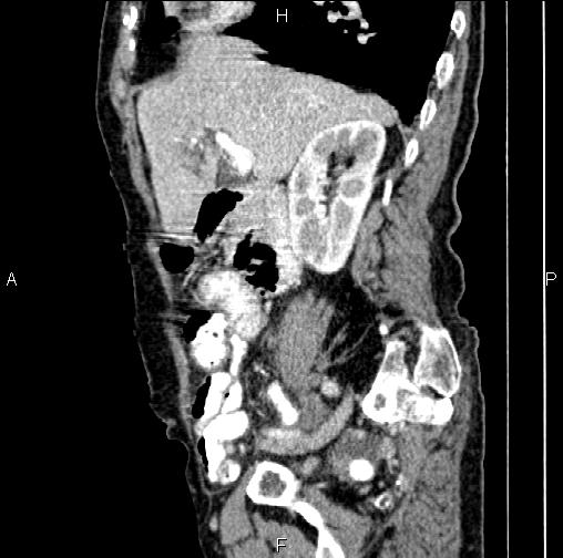 File:Aortic aneurysm and Lemmel syndrome (Radiopaedia 86499-102554 D 29).jpg