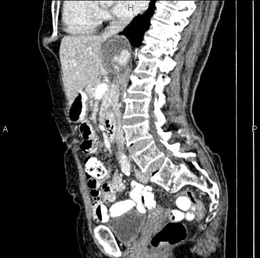 Aortic aneurysm and Lemmel syndrome (Radiopaedia 86499-102554 D 42).jpg