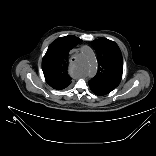 Aortic arch aneurysm (Radiopaedia 84109-99365 Axial non-contrast 94).jpg