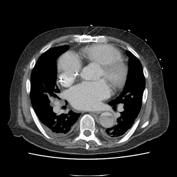Aortic arch graft infection (FDG PET-CT) (Radiopaedia 71975-82437 A 33).jpg