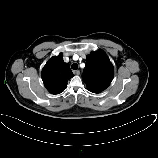 File:Aortic arch origin of left vertebral artery (Radiopaedia 46327-50737 Axial post contrast 26).jpg