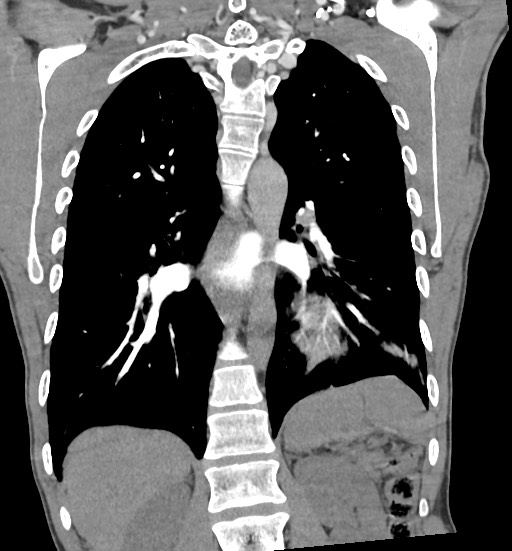 Aortic coarctation with aneurysm (Radiopaedia 74818-85828 C 79).jpg
