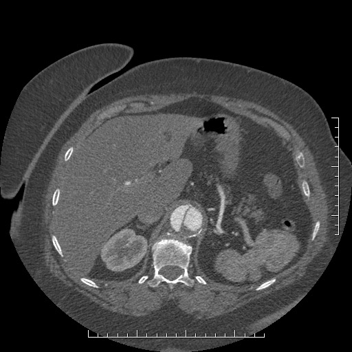 Aortic dissection- Stanford A (Radiopaedia 35729-37268 B 38).jpg
