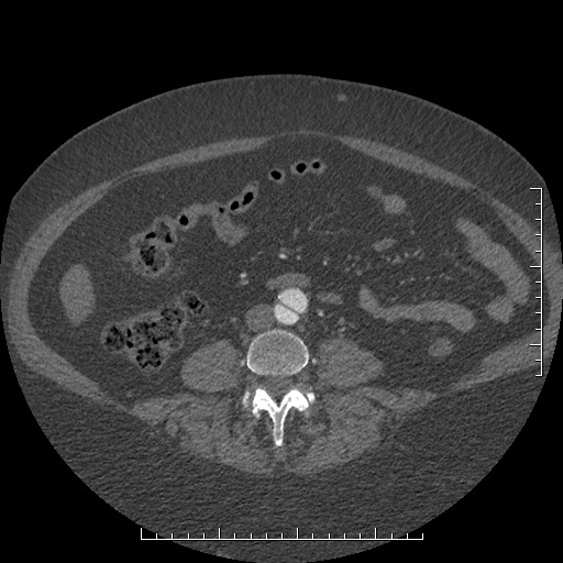 File:Aortic dissection- Stanford A (Radiopaedia 35729-37268 C 32).jpg