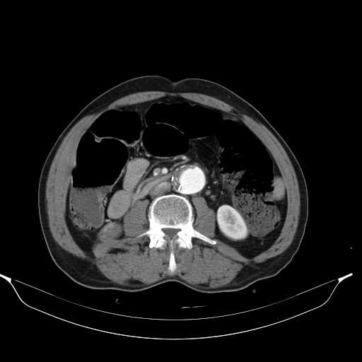 Aortic dissection- Stanford type A (Radiopaedia 22085-22085 A 54).jpg