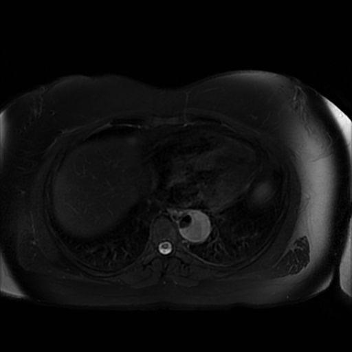 File:Aortic dissection (Radiopaedia 57969-64956 Axial T2 fat sat 8).jpg