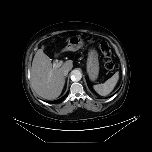 Aortic dissection (Radiopaedia 62562-71000 A 48).jpg