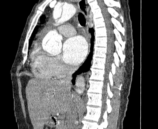 Aortic dissection - Stanford A -DeBakey I (Radiopaedia 28339-28587 C 23).jpg