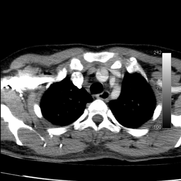 Aortic dissection - Stanford type A (Radiopaedia 29247-29659 A 15).jpg