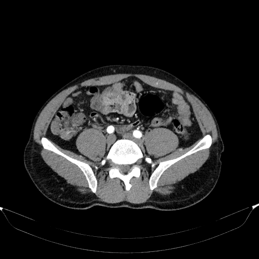 File:Aortic dissection - Stanford type A (Radiopaedia 83418-98500 A 96).jpg