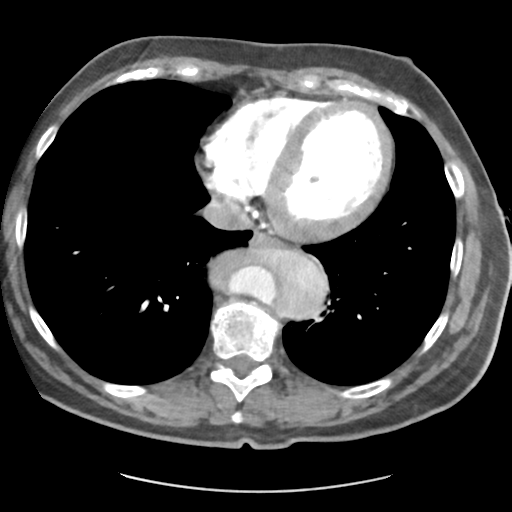File:Aortic dissection - Stanford type B (Radiopaedia 50171-55512 A 37).png