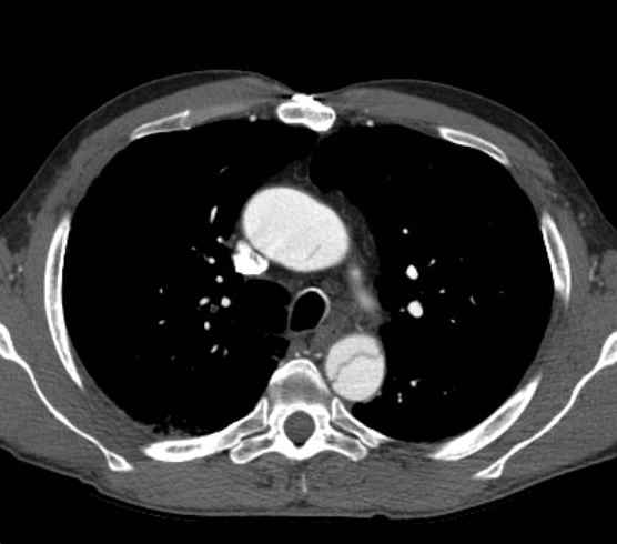 Aortic dissection - Stanford type B (Radiopaedia 73648-84437 A 31).jpg