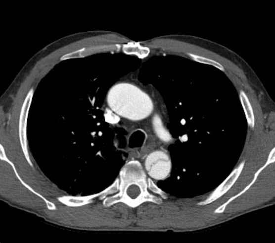 Aortic dissection - Stanford type B (Radiopaedia 73648-84437 A 32).jpg