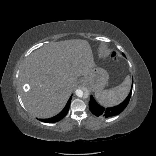Aortic dissection - Stanford type B (Radiopaedia 88281-104910 A 84).jpg