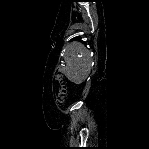 File:Aortic dissection - Stanford type B (Radiopaedia 88281-104910 C 8).jpg